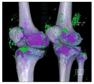 DECT of Gout in the Knees