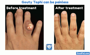 Gouty Tophi Can Be Painless Photograph